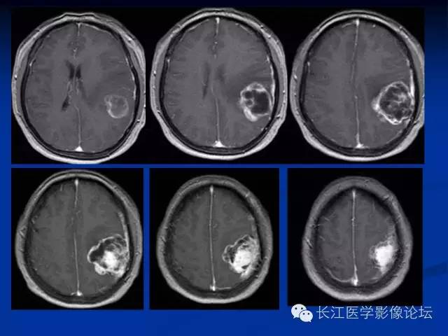 【病例】微囊型脑膜瘤1例MR影像表现与鉴别