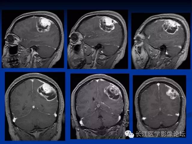 【病例】微囊型脑膜瘤1例MR影像表现与鉴别