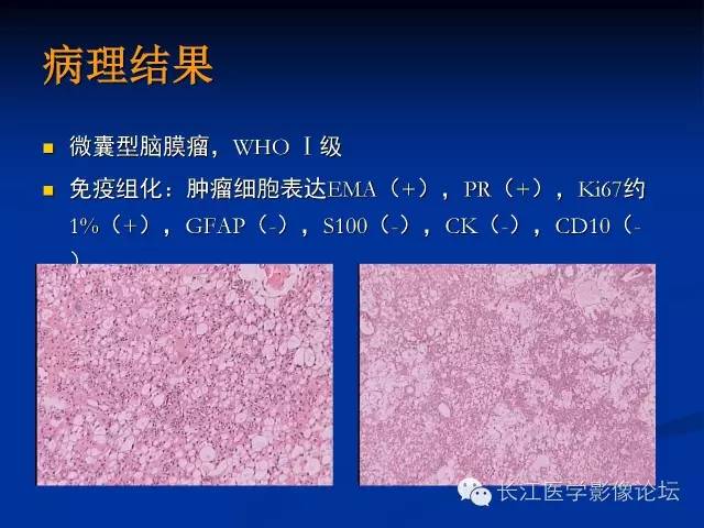 【病例】微囊型脑膜瘤1例MR影像表现与鉴别