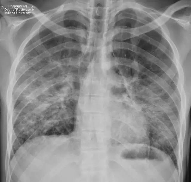 【病例】滋病患者肺孢子虫肺炎1例CT影像表现 【病例】滋病患者肺孢子虫肺炎1例CT影像表现