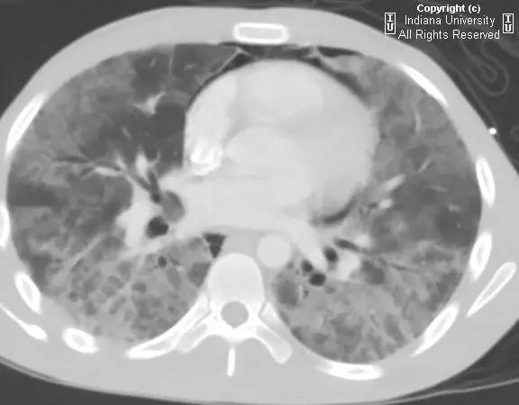 【病例】滋病患者肺孢子虫肺炎1例CT影像表现 【病例】滋病患者肺孢子虫肺炎1例CT影像表现