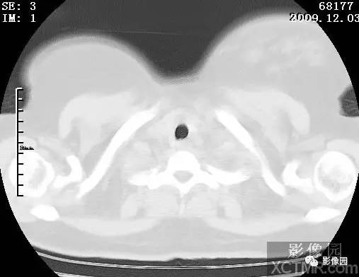 【病例】甲型H1N1流感1例CT 【病例】甲型H1N1流感1例CT