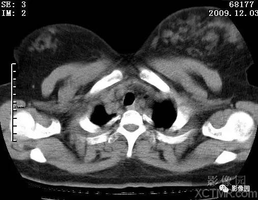 【病例】甲型H1N1流感1例CT 【病例】甲型H1N1流感1例CT