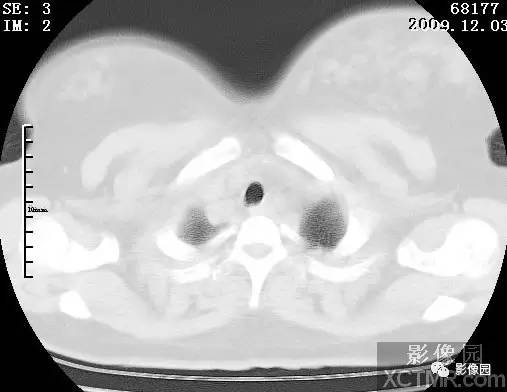 【病例】甲型H1N1流感1例CT 【病例】甲型H1N1流感1例CT