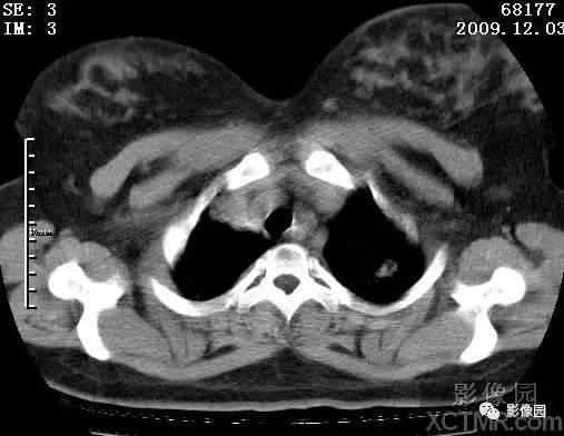 【病例】甲型H1N1流感1例CT 【病例】甲型H1N1流感1例CT