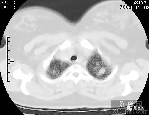 【病例】甲型H1N1流感1例CT 【病例】甲型H1N1流感1例CT