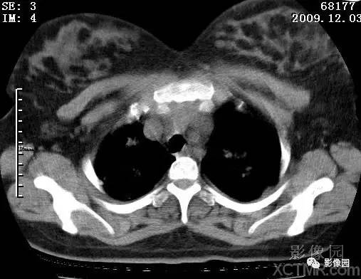 【病例】甲型H1N1流感1例CT 【病例】甲型H1N1流感1例CT