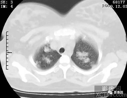 【病例】甲型H1N1流感1例CT 【病例】甲型H1N1流感1例CT