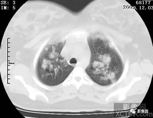【病例】甲型H1N1流感1例CT 【病例】甲型H1N1流感1例CT
