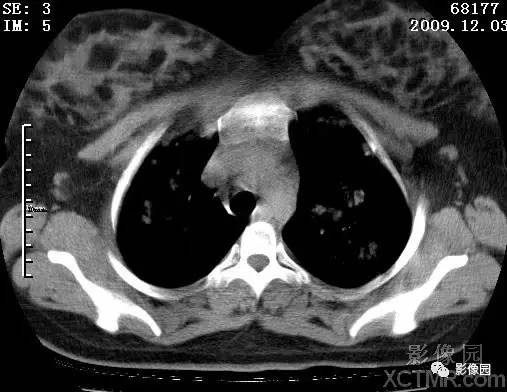 【病例】甲型H1N1流感1例CT 【病例】甲型H1N1流感1例CT
