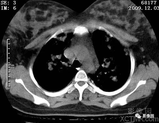 【病例】甲型H1N1流感1例CT 【病例】甲型H1N1流感1例CT