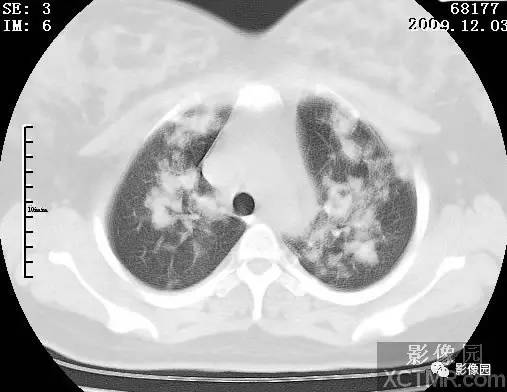 【病例】甲型H1N1流感1例CT 【病例】甲型H1N1流感1例CT