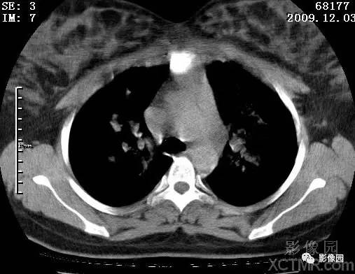 【病例】甲型H1N1流感1例CT 【病例】甲型H1N1流感1例CT