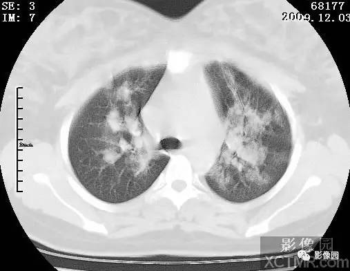 【病例】甲型H1N1流感1例CT 【病例】甲型H1N1流感1例CT