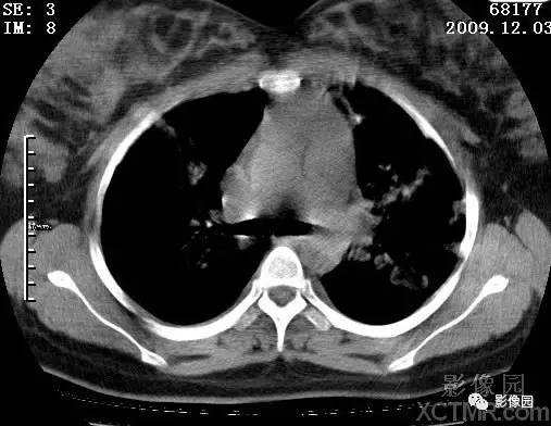 【病例】甲型H1N1流感1例CT 【病例】甲型H1N1流感1例CT