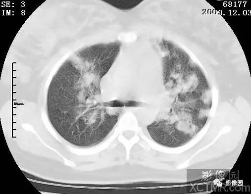 【病例】甲型H1N1流感1例CT 【病例】甲型H1N1流感1例CT