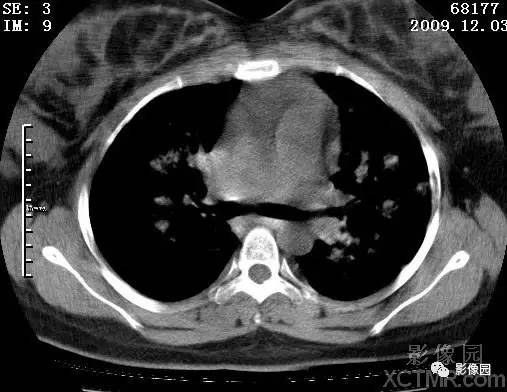 【病例】甲型H1N1流感1例CT 【病例】甲型H1N1流感1例CT
