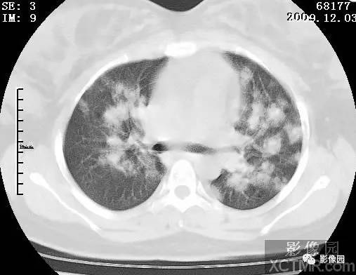 【病例】甲型H1N1流感1例CT