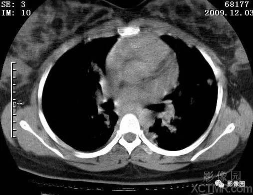 【病例】甲型H1N1流感1例CT 【病例】甲型H1N1流感1例CT
