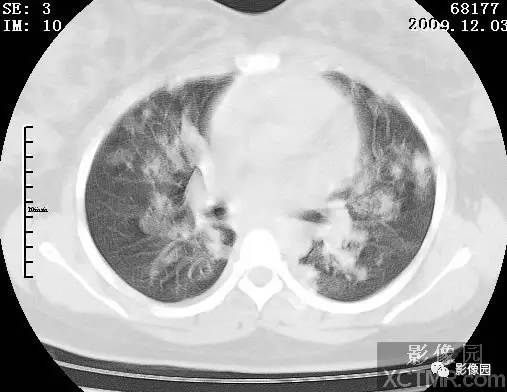 【病例】甲型H1N1流感1例CT 【病例】甲型H1N1流感1例CT