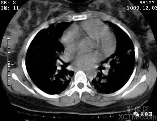 【病例】甲型H1N1流感1例CT 【病例】甲型H1N1流感1例CT