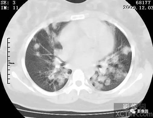 【病例】甲型H1N1流感1例CT 【病例】甲型H1N1流感1例CT