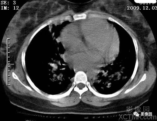 【病例】甲型H1N1流感1例CT 【病例】甲型H1N1流感1例CT