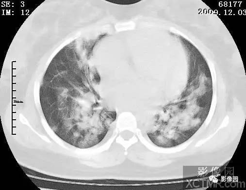【病例】甲型H1N1流感1例CT 【病例】甲型H1N1流感1例CT