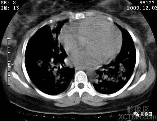 【病例】甲型H1N1流感1例CT 【病例】甲型H1N1流感1例CT