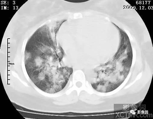 【病例】甲型H1N1流感1例CT 【病例】甲型H1N1流感1例CT