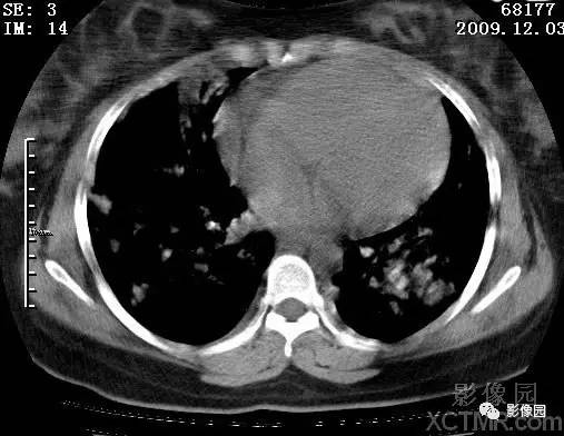 【病例】甲型H1N1流感1例CT 【病例】甲型H1N1流感1例CT