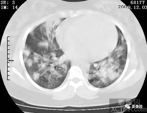 【病例】甲型H1N1流感1例CT 【病例】甲型H1N1流感1例CT