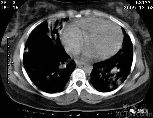 【病例】甲型H1N1流感1例CT 【病例】甲型H1N1流感1例CT