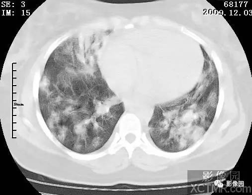 【病例】甲型H1N1流感1例CT 【病例】甲型H1N1流感1例CT