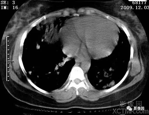 【病例】甲型H1N1流感1例CT 【病例】甲型H1N1流感1例CT