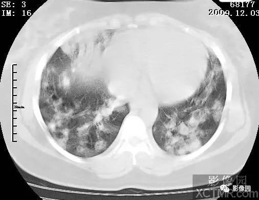 【病例】甲型H1N1流感1例CT 【病例】甲型H1N1流感1例CT