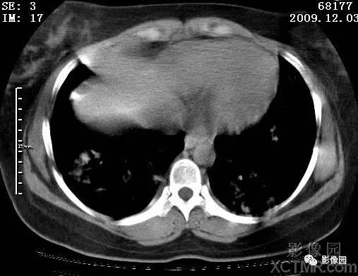 【病例】甲型H1N1流感1例CT 【病例】甲型H1N1流感1例CT