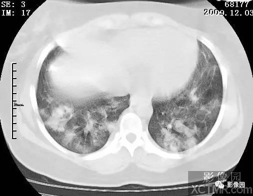 【病例】甲型H1N1流感1例CT 【病例】甲型H1N1流感1例CT