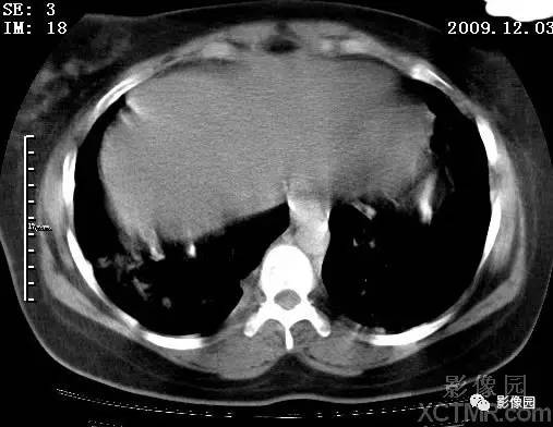 【病例】甲型H1N1流感1例CT 【病例】甲型H1N1流感1例CT