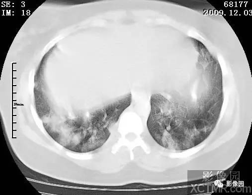 【病例】甲型H1N1流感1例CT 【病例】甲型H1N1流感1例CT