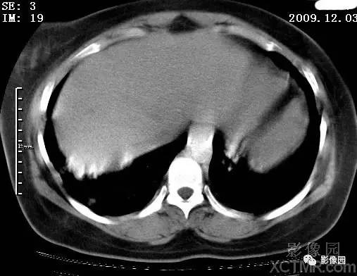 【病例】甲型H1N1流感1例CT 【病例】甲型H1N1流感1例CT