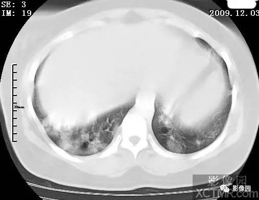 【病例】甲型H1N1流感1例CT 【病例】甲型H1N1流感1例CT