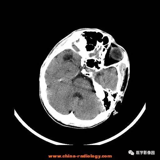 【病例】一氧化碳中毒1例CT影像表现 【病例】一氧化碳中毒1例CT影像表现