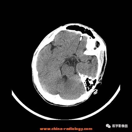 【病例】一氧化碳中毒1例CT影像表现 【病例】一氧化碳中毒1例CT影像表现