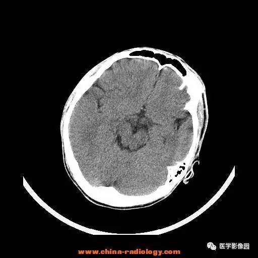 【病例】一氧化碳中毒1例CT影像表现 【病例】一氧化碳中毒1例CT影像表现