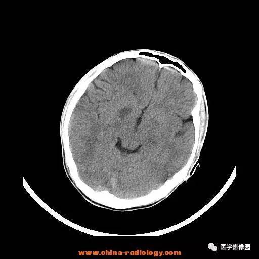 【病例】一氧化碳中毒1例CT影像表现 【病例】一氧化碳中毒1例CT影像表现