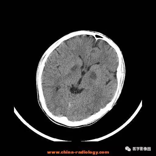 【病例】一氧化碳中毒1例CT影像表现