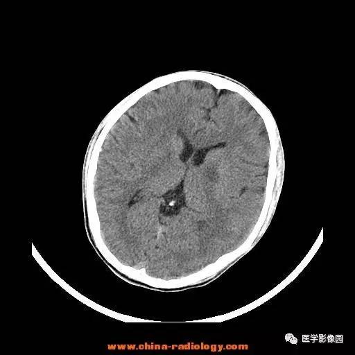 【病例】一氧化碳中毒1例CT影像表现 【病例】一氧化碳中毒1例CT影像表现