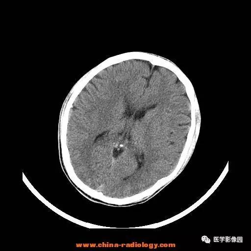 【病例】一氧化碳中毒1例CT影像表现 【病例】一氧化碳中毒1例CT影像表现