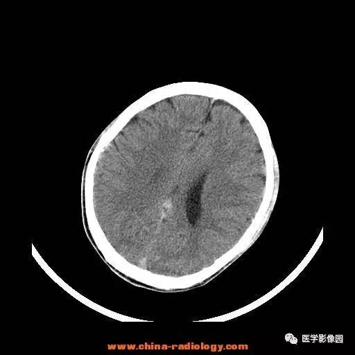 【病例】一氧化碳中毒1例CT影像表现 【病例】一氧化碳中毒1例CT影像表现